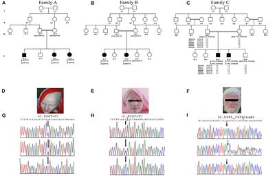 Identification and Computational Analysis of Novel TYR and SLC45A2 Gene Mutations in Pakistani Families With Identical Non-syndromic Oculocutaneous Albinism